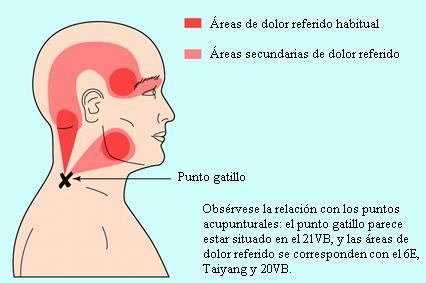 Puntos gatillo