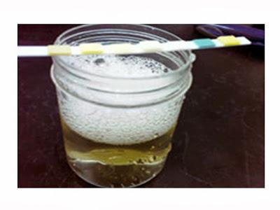 Proteinuria: evaluación del paciente adulto en Atención Primaria