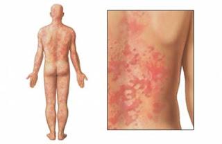 urticaria