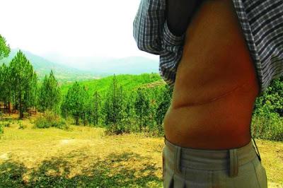 El 10% de los Órganos que se Trasplantan en el Mundo Proceden del Tráfico ilegal