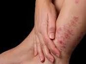 psoriasis
