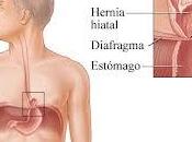 hernia hiato