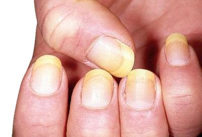 El color y forma de las uñas ayudan a diagnosticar ciertas enfermedades