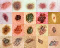 DOS NOTICIAS SOBRE EL MELANOMA: ES MAS MORTAL EN HOMBRE QUE EN MUJERES Y ES 4 VECES MAS FRECUENTE EN PACIENTES CON PARKINSON