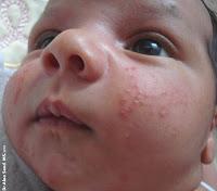 Variedades de acné en pediatría Variedades de acné en pediatría