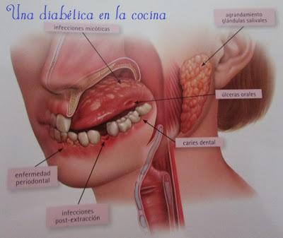 La diabetes y la salud bucodental