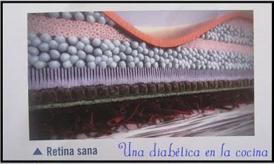 El edema macular daibético (EMD)