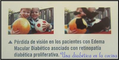 El edema macular daibético (EMD)