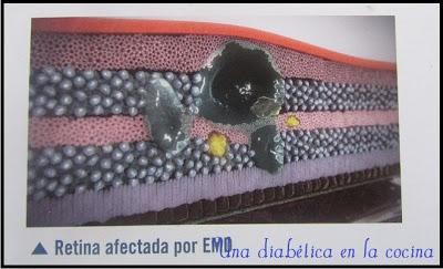 El edema macular daibético (EMD)