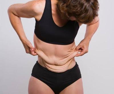 LA CIRUGIA DESPUES DEL EMBARAZO