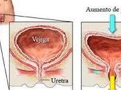 incontinencia urinaria