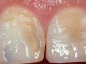 Cómo prevenir erosión esmalte dental
