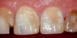 Cómo prevenir la erosión del esmalte dental