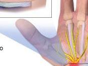 solución natural para síndrome túnel carpiano