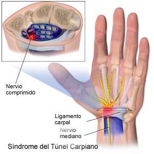 sindrome_tunel_carpiano