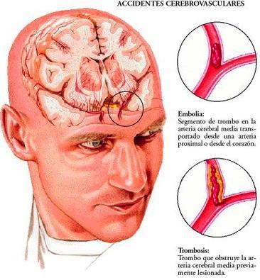 emboliacerebral