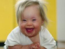 Más cerca de un posible tratamiento del síndrome de Down