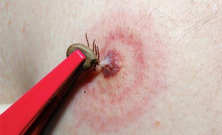 Precauciones en picaduras de garrapatas picadura-garrapata