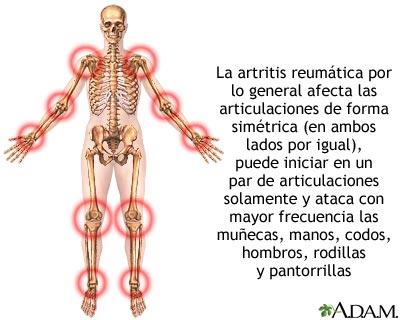 remedios caseros para artritis reumatoide manos remedios caseros para artritis reumatoide manos