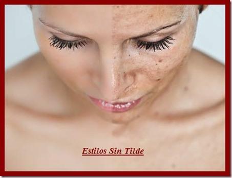 Diferencia las manchas en la piel manchas 2 thumb Cómo diferenciar las manchas en la piel