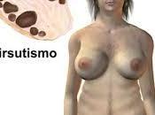 hirsutismo