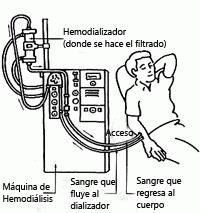 ¿Qué es un dializador?