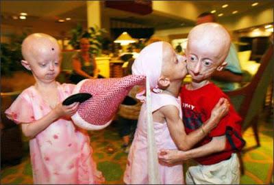 Progeria: niños ancianos con una esperanza