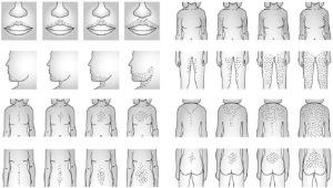 Grados de hirsutismo