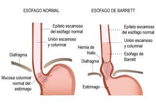 Esófago de Barret y SmartSalus