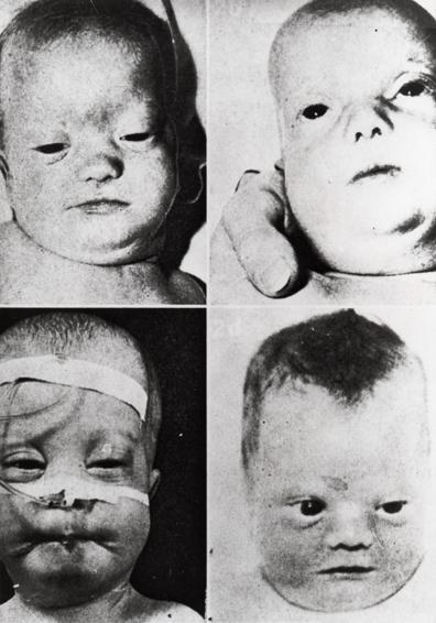 Enfermedades causadas por el peroxisoma