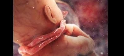 CORDÓN UMBILICAL ENRROLLADO