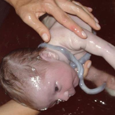 CORDÓN UMBILICAL ENRROLLADO