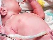 Panico: Cordón umbilical alrededor cuello bebé