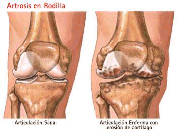 Terapia celular contra la artrosis de rodilla