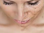 Piel sana, uniforme manchas después verano tratamientos láser