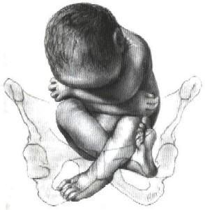 Mi bebé de nalgas se dio la vuelta en la semana 37 Mi bebé de nalgas se dio la vuelta en la semana 37