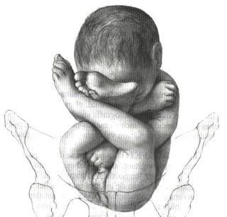 Mi bebé de nalgas se dio la vuelta en la semana 37 Mi bebé de nalgas se dio la vuelta en la semana 37