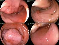 Nuevo Anticuerpo Predice el Riesgo de Cancer Intestinal