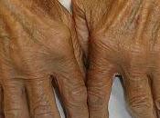 Artritis ósea artritis reumática