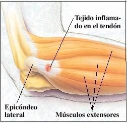 Lesiones de codo