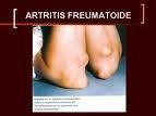 La artritis reumatoide en cifras