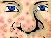 Combate acné vitamina