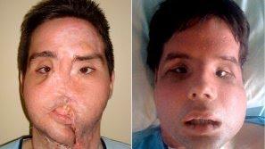 El primer receptor de una cara completa recobra su identidad tras la operación de Barcelona hace tres meses