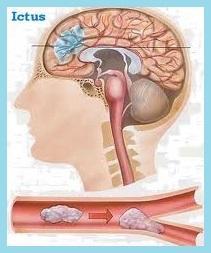 Cómo reconocer los síntomas del ictus. Descargar guía actuación contra ictus. Cómo reconocer los síntomas del ictus. Descargar guía actuación contra ictus.