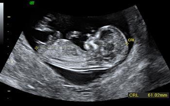 Ecografía del tercer trimestre