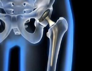 Protesis-cadera1