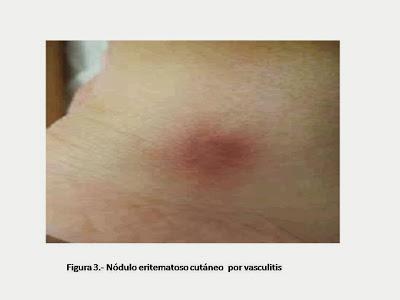 Nódulo eritematoso