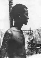 Rahima y Ali, los últimos afectados de viruela Rahima y Ali, los últimos afectados de viruela