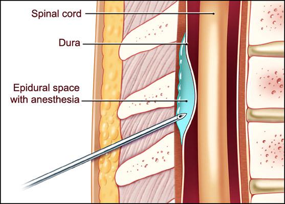 Espinal y epidural o lo que tiene que ver el culo con las témporas