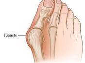 famosos juanetes. producen como solucionarlos.
